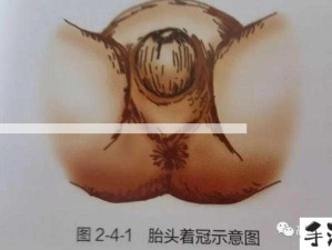 男子胎头受压回缩：如何应对胎头被“坐回”的情况？